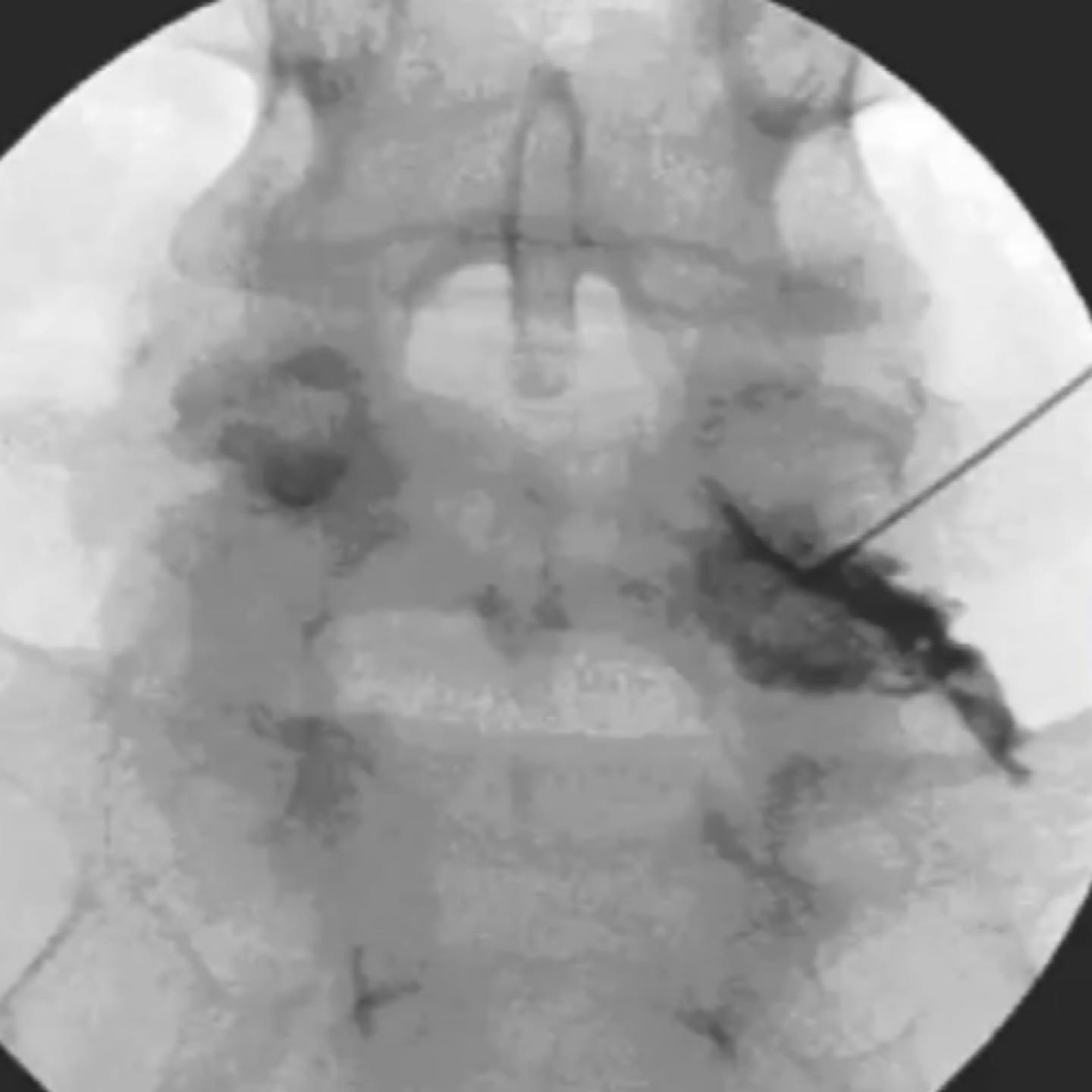 A transforaminal selective nerve... - Neuro & Spine Clinic
