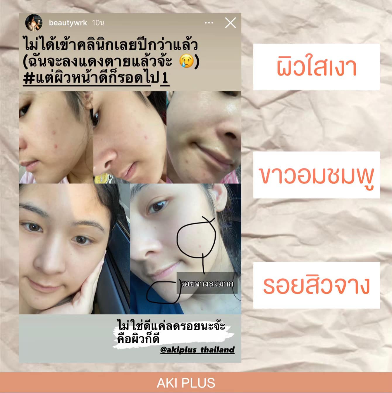 Aki Plus วิตามินฟื้นฟูผิวเสีย ลดสิว จากประเทศญี่ปุ่น-ตัวแทนรายใหญ่ - Home