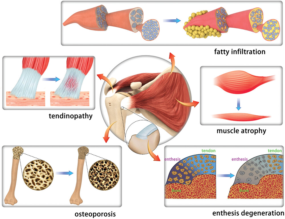 Professor - Ageing-related pathological degenerations in rotator cuff ☑ ...