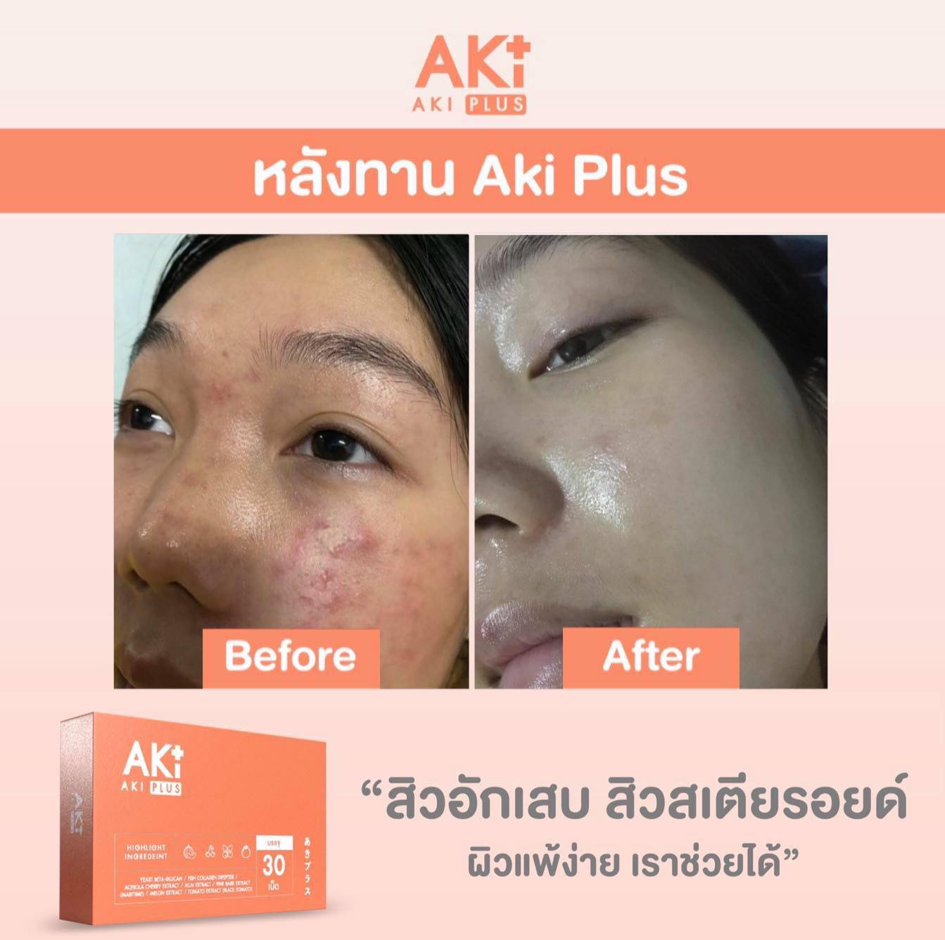 AKI Plus วิตามินลดสิว ตัวแทนรายใหญ่