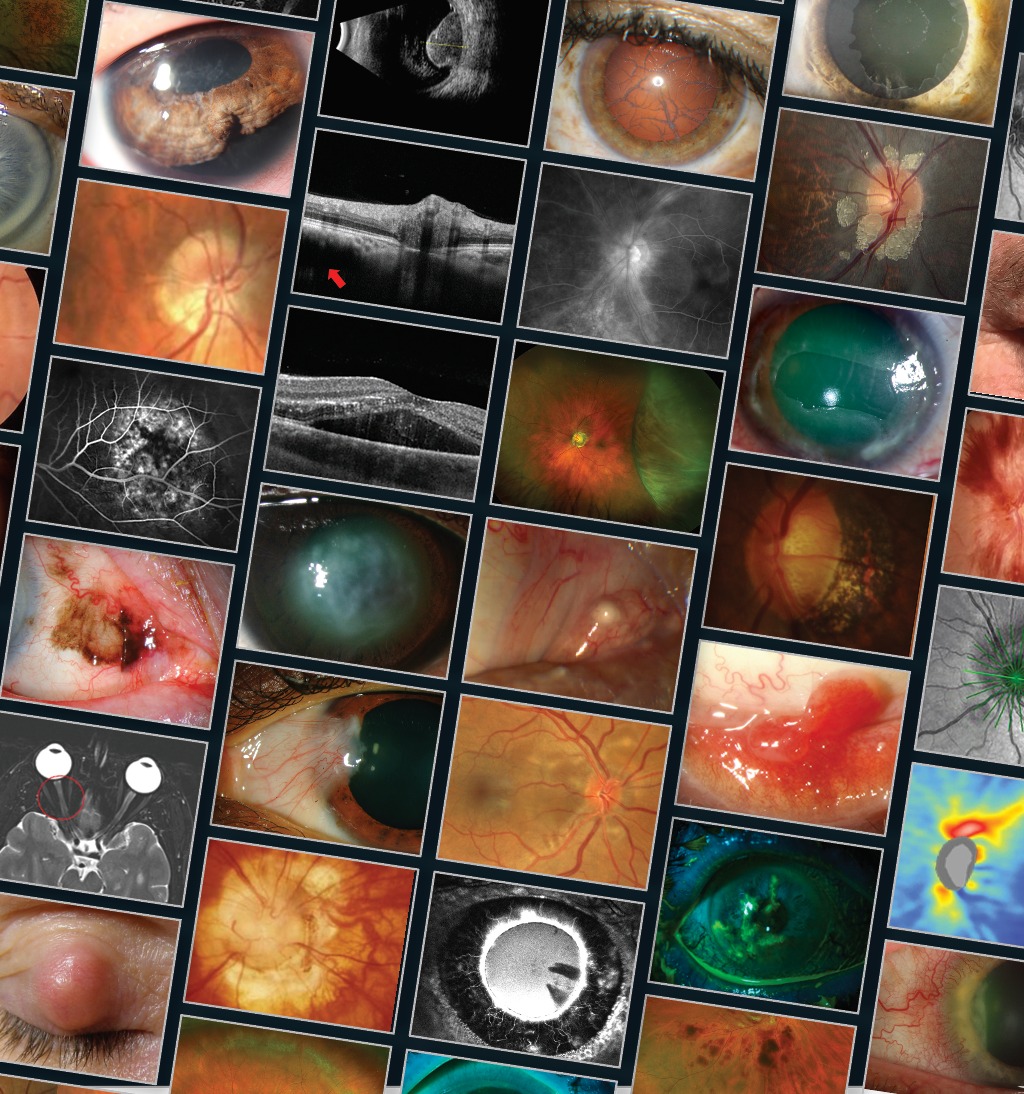 Here's a sampling of anterior segment disease photos from our new