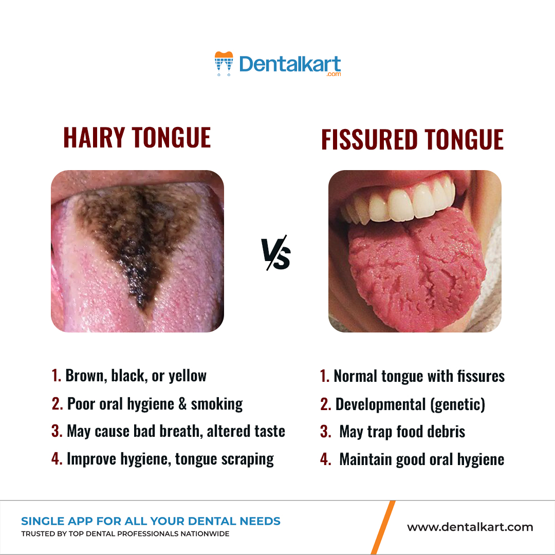 𝐇𝐚𝐢𝐫𝐲 𝐓𝐨𝐧𝐠𝐮𝐞 𝐯𝐬. 𝐅𝐢𝐬𝐬𝐮𝐫𝐞𝐝 𝐓𝐨𝐧𝐠𝐮𝐞!💡 Not all  tongue changes are harmful, but they can signal issues with hygiene or  health. ✓ Improve diagnosis ✓ Educate your patients ✓ Recommend the right  care