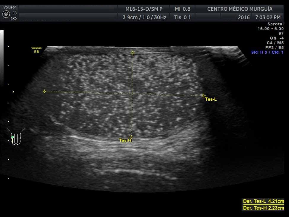 MICROLITIASIS TESTICULAR... - Centro Médico Murguia | Facebook