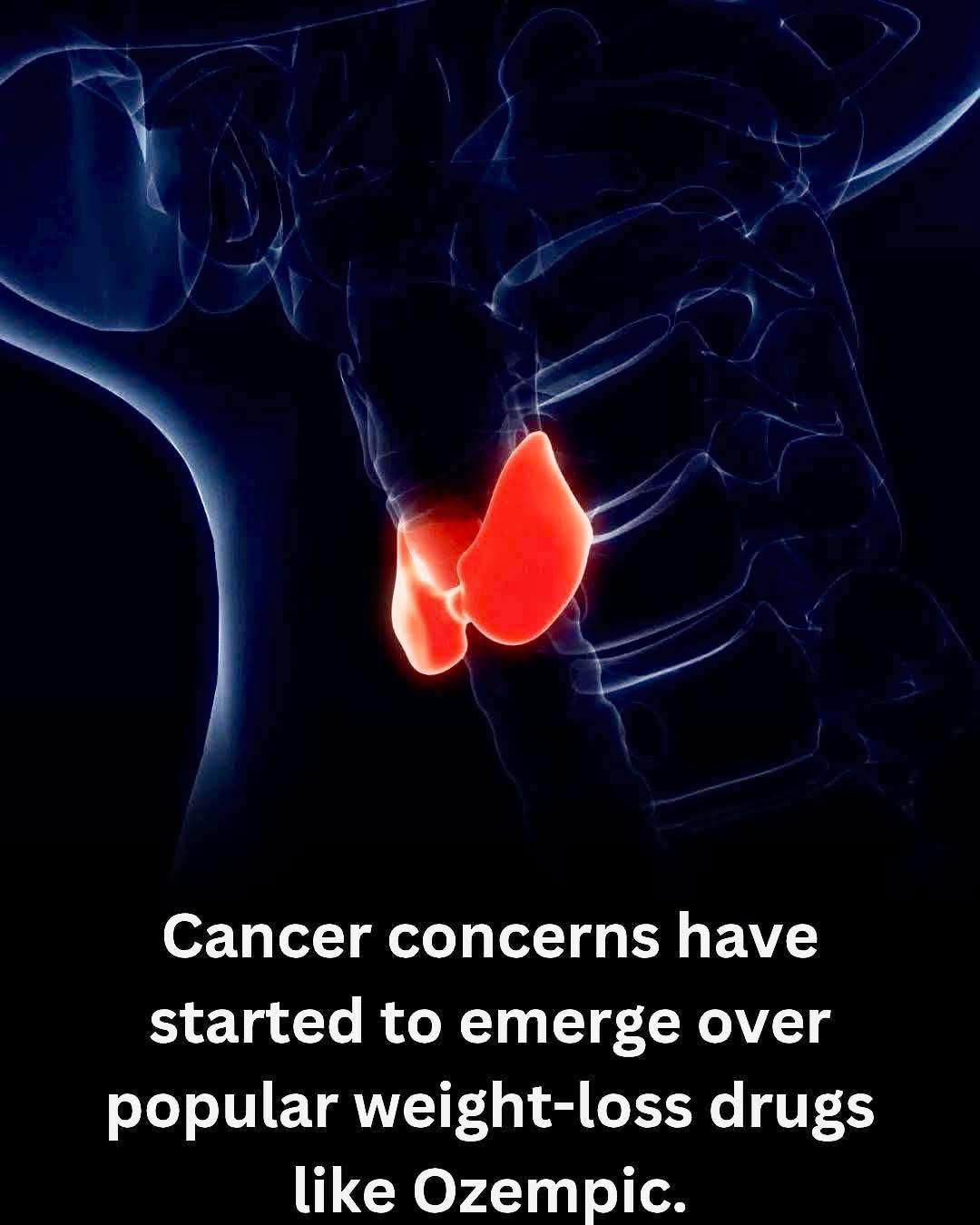 ⚠️Cancer Concerns Around Popular Weight-Loss Drugs Like Ozempic 🔺 Breakthrough medications like Ozempic, Wegovy, and Mounjaro - all GLP-1 receptor agonists