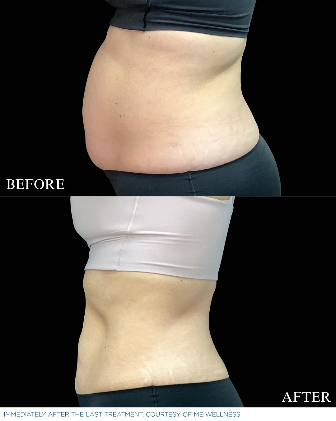 Upward - 🔥 EMSCULPT NEO: Abs Transformed! 🔥 Check out these amazing ...