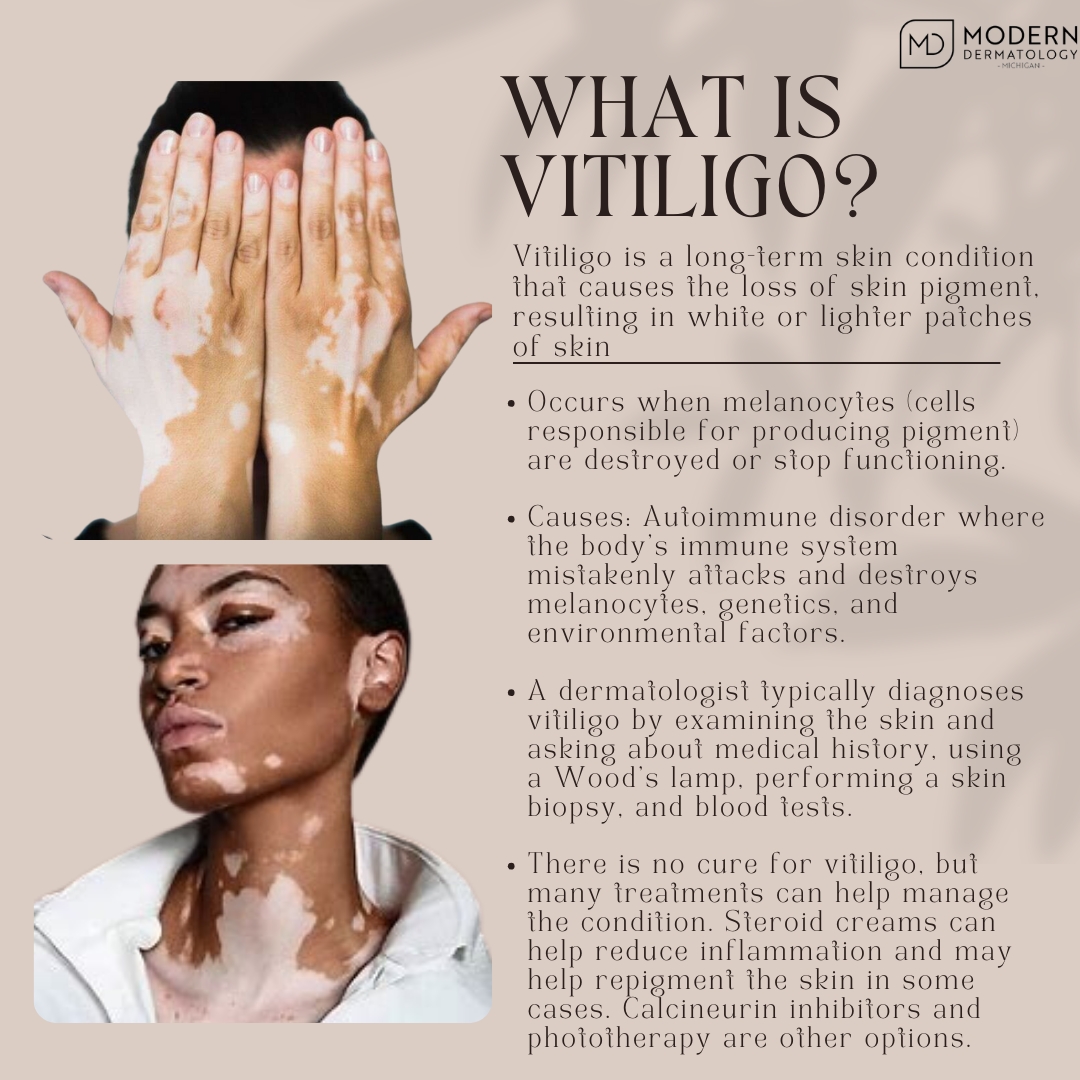 Modern - Vitiligo is a long-term skin condition that causes the loss of ...