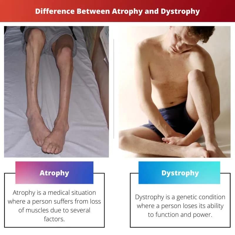 ☑️Difference Between Atrophy and... - ضمور العضلات الشوكي