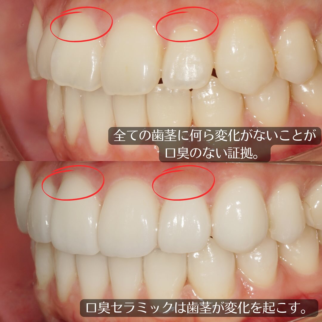 ワイズデンタルキュア - 前回の歯列矯正後の歯茎がみえるのがコンプレックスの方のお口の中です。 奥歯と上前歯はセラミック製。下の前歯は再度歯列 ...