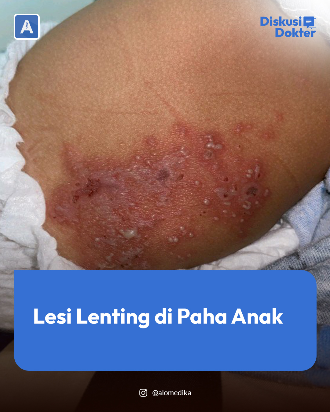 Alomedika - ALO Dokter, Seorang anak berusia 1 tahun 7 bulan datang ...