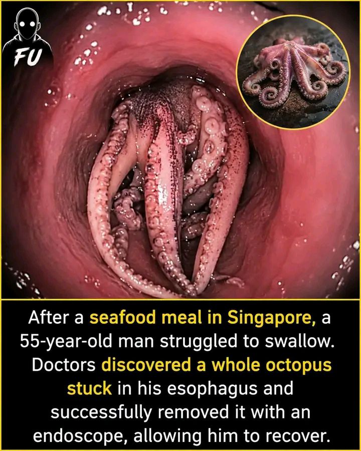 A whole octopus. That's what doctors at Tan Tock Seng Hospital