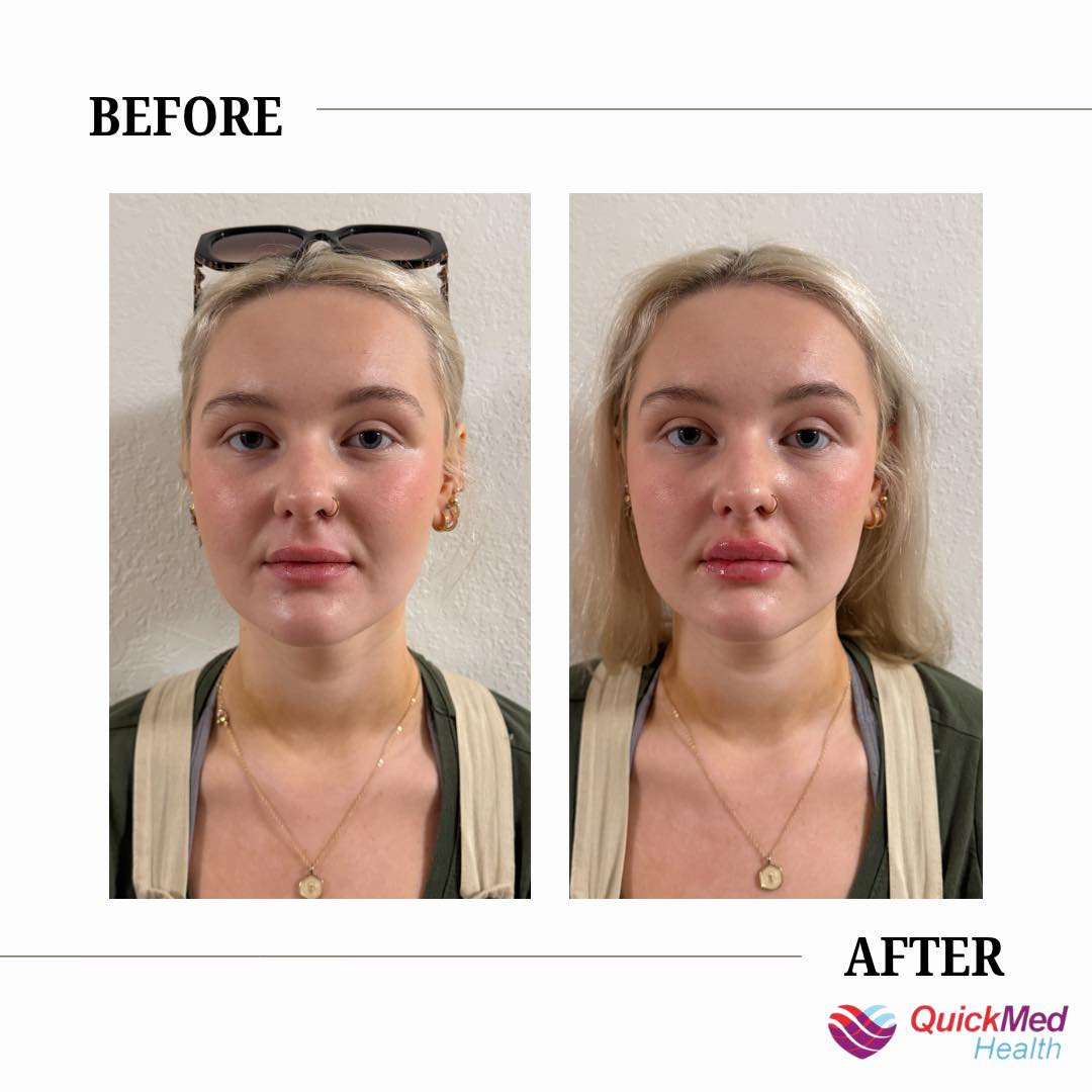 New at QuickMed Health! 🎉 Ever heard of KLOW + GLOW peptides and wondered what the hype is about? Let us break it down for you! 💧 KLOW Supports healthy skin, hair