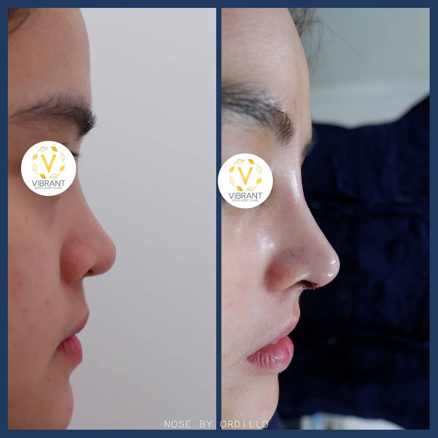 Removal of HA... - Vibrant Skin & Body Clinic by Dr. Ordillo | Facebook