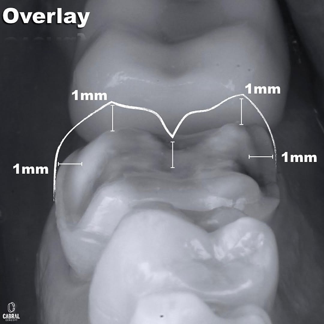 Portal Odontólogos - Pasos en la extracción del tercer molar mandibular ...