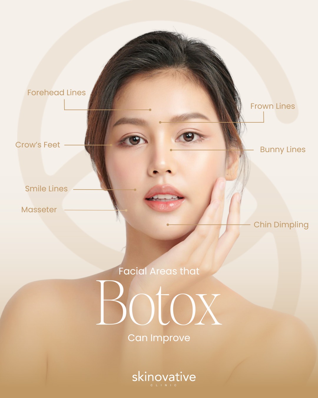 Skinovative - Botox 101: The complete facial mapping guide! 📚 Did you ...