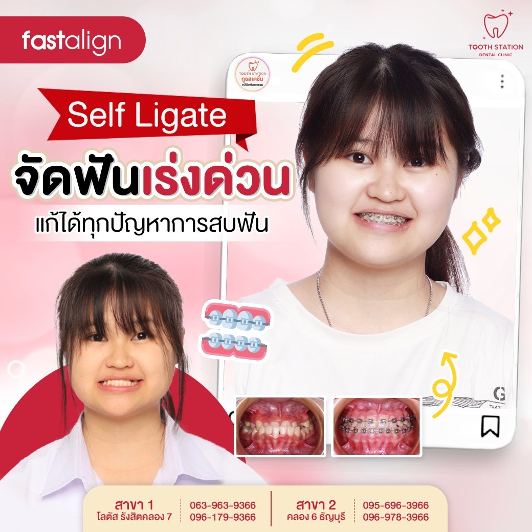 เคสยากแค่ไหน จัดฟัน Self Ligate แก้ไขได้ ด้วยเทคนิค Fastalign หนึ่ง ...
