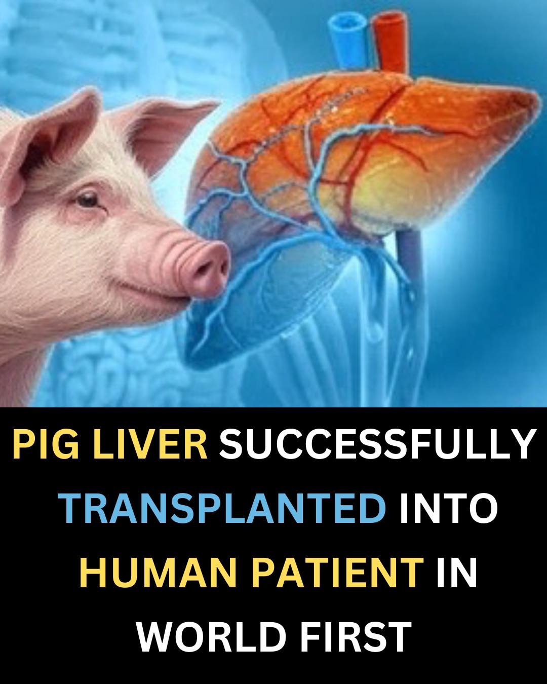 Only - Pig Liver Successfully Transplanted Into Human Patient in World ...