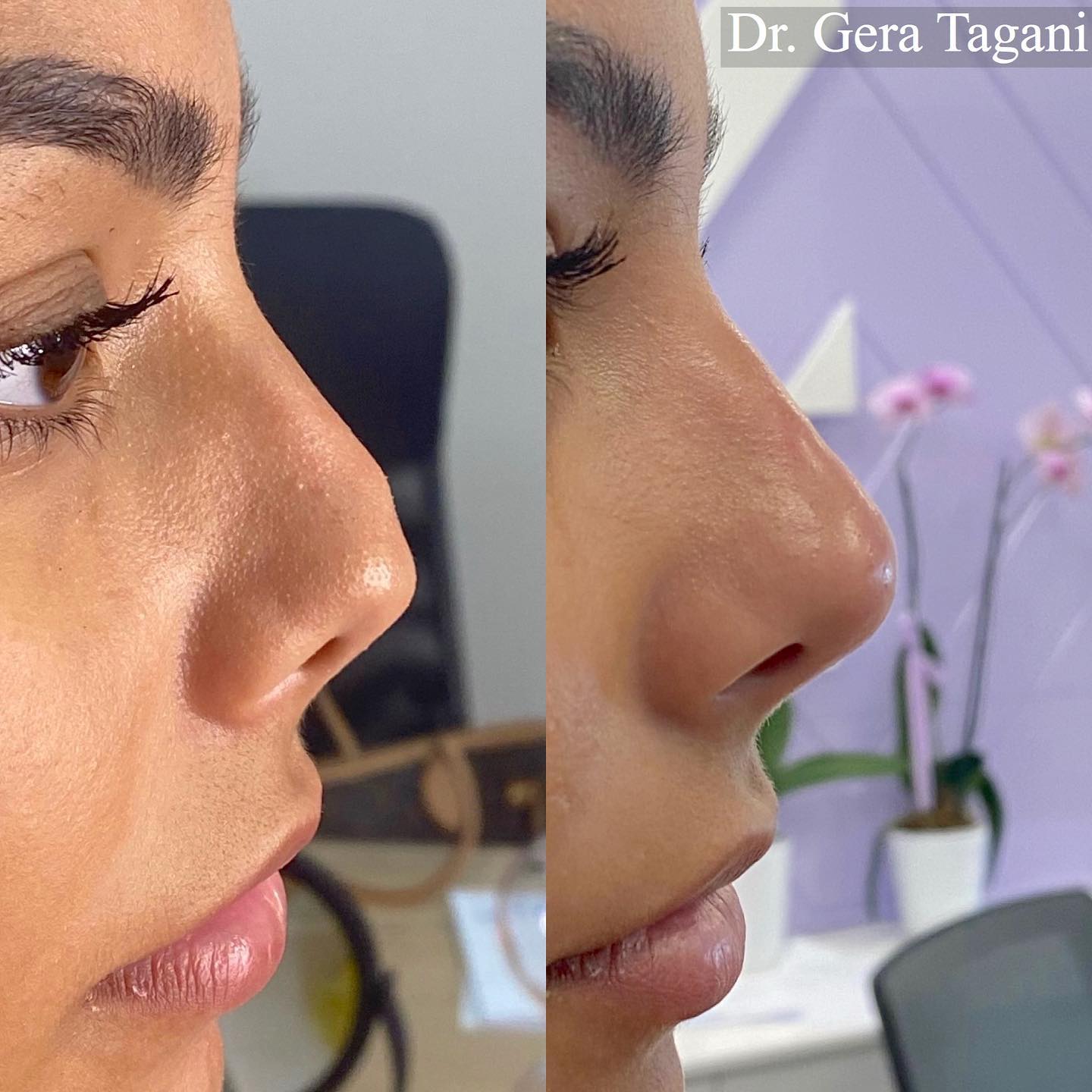 Dr. Gera Tagani - ️correction work of a surgical procedure that ...