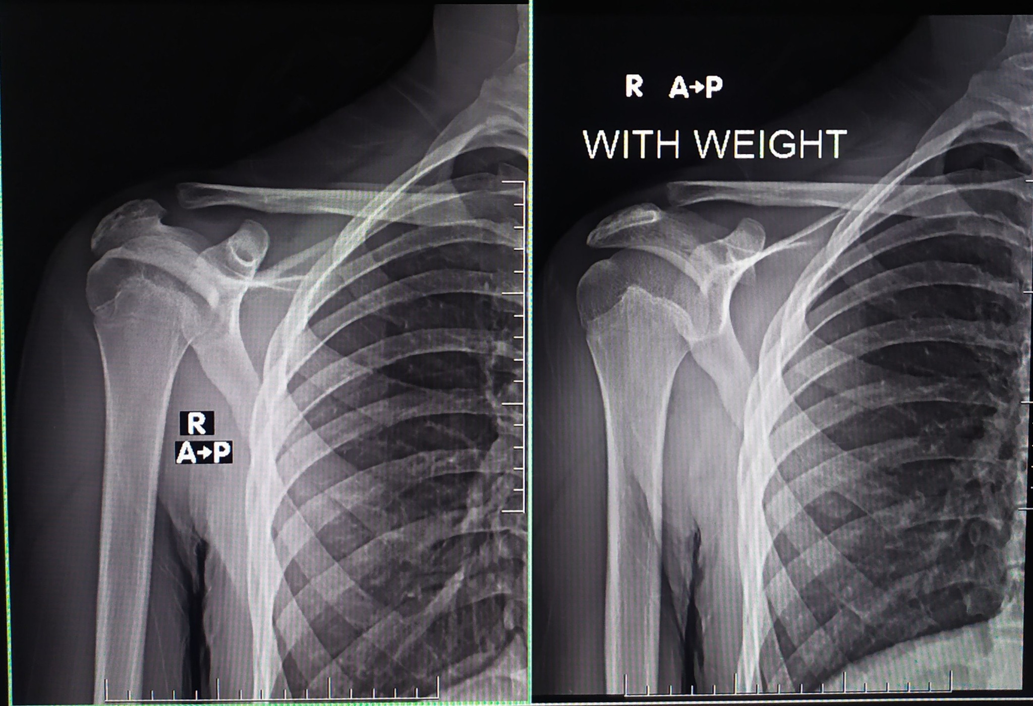 X Ray Rt Shoulder أشعة عاديه ديجيتال بالكمبيوتر على مفصل الكتف ...