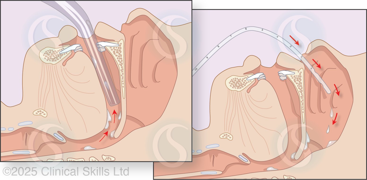 Clinical - Oropharyngeal and nasopharyngeal suctioning in infants and ...