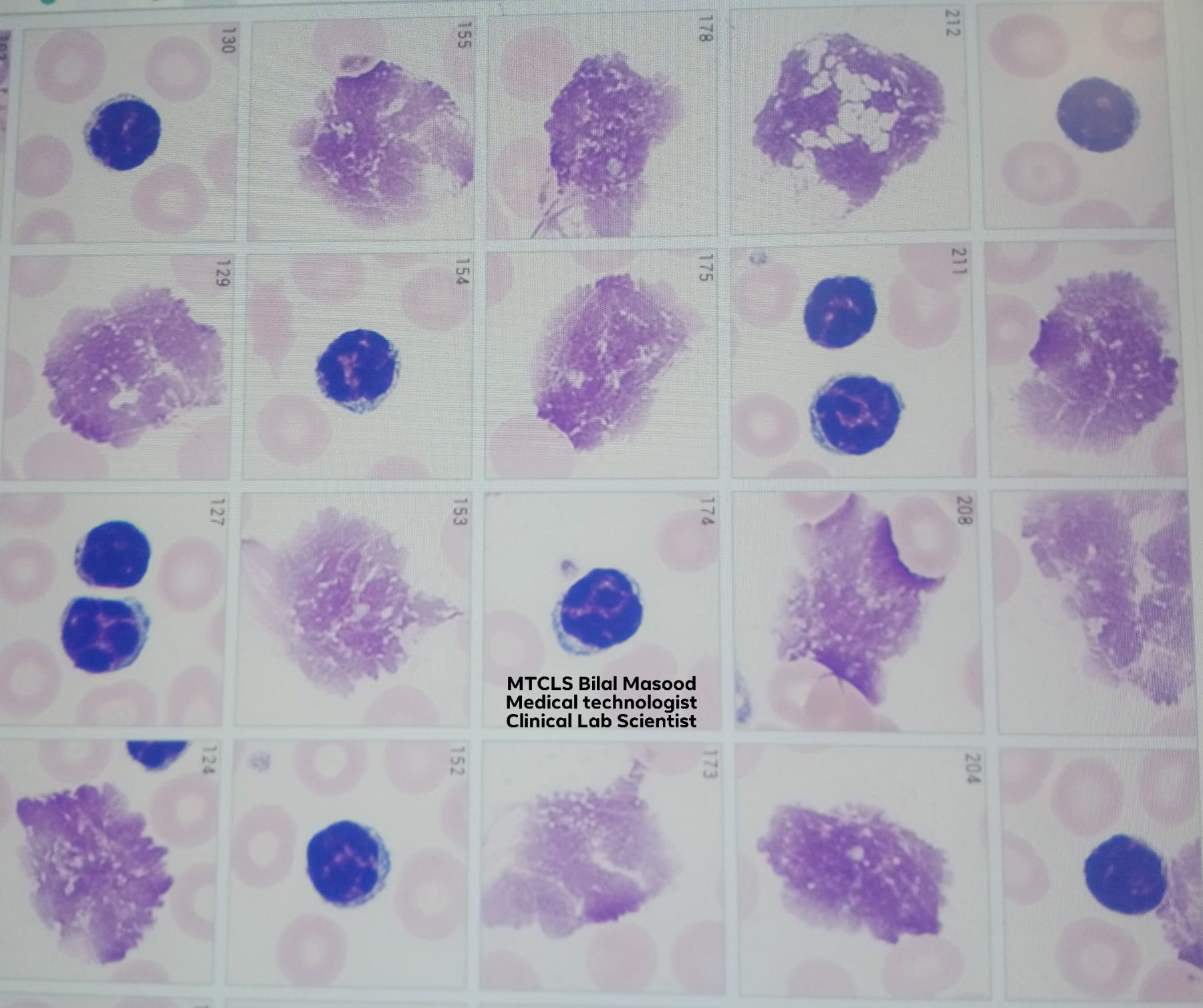 MTCLS - What's the diagnosis based on this blood smear morphology? 🟣 ...
