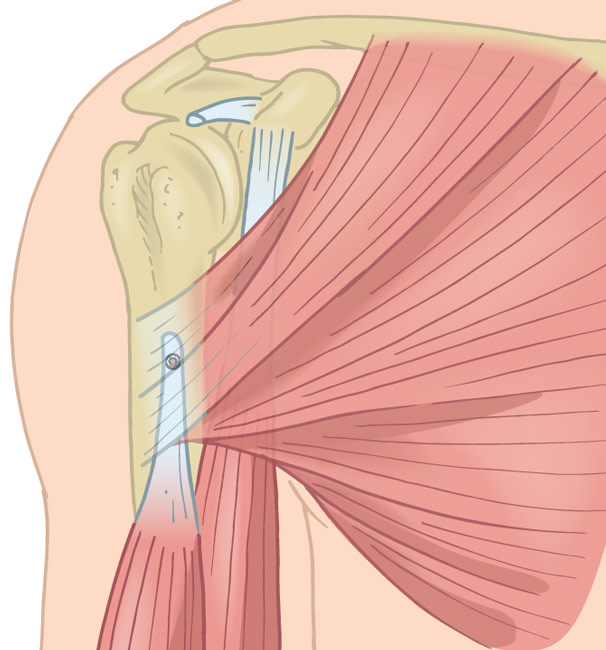 bicep tenodesis bpc 157 Is a Biceps the Answer? https://mikereinold.com/is-a-biceps- tenodesis-the-answer How to Use These in vitro peptide research Chemical purity:>99%