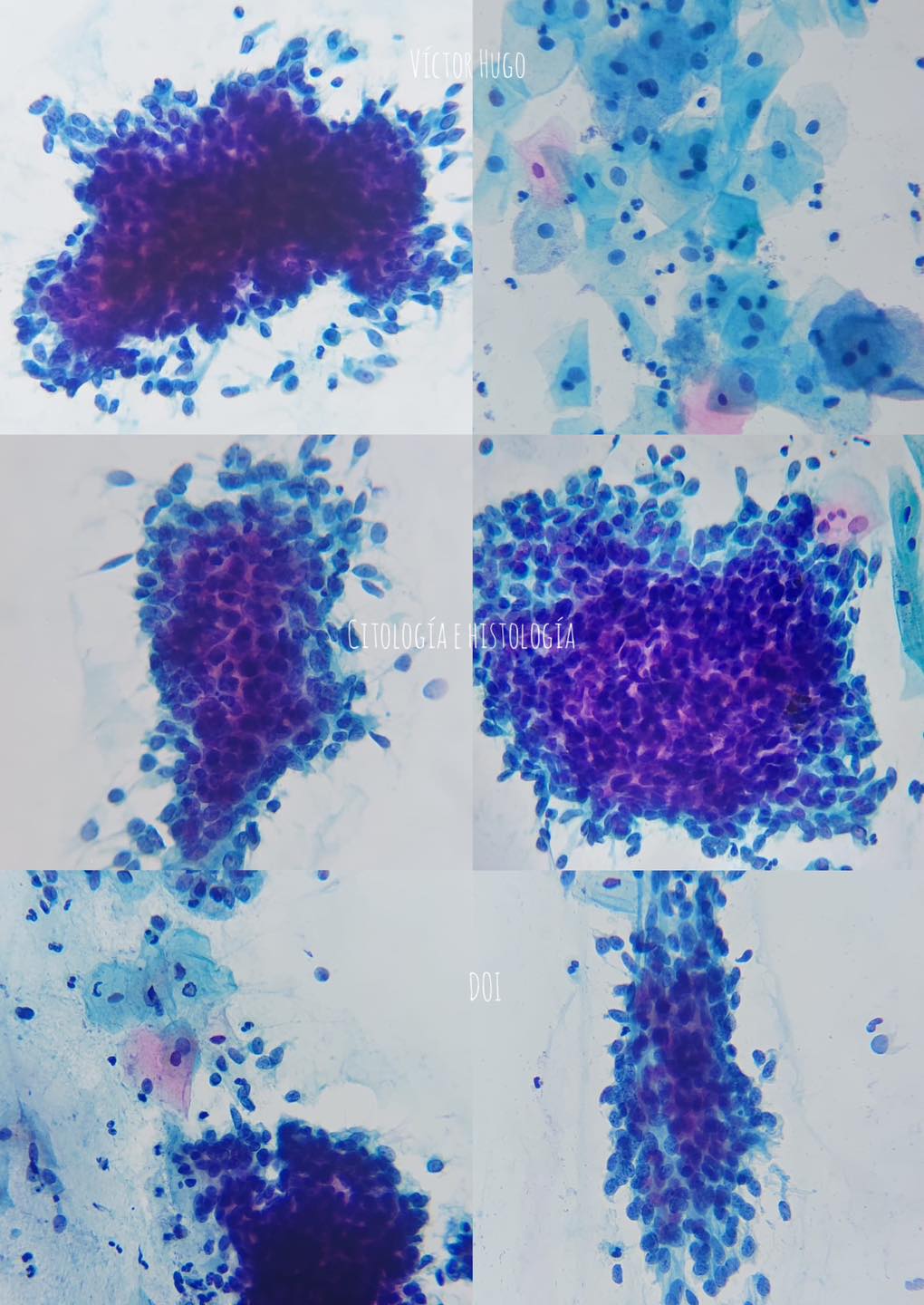 Citología e Histología - Bye os días! CCV, 40 años, colposcopia normal ...
