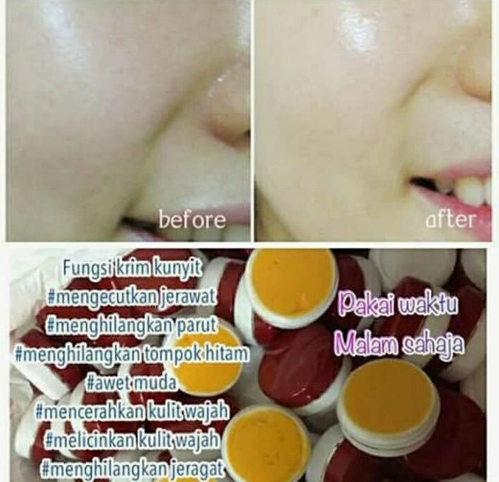 Laci Kita3 Krim Kunyit Hanys Rm5 Pcs Banyak Manfaat Nyaaa Mengecutkan Jerawat Menghilangkan Jeragat Awet Muda Melicinkan Kulit Muka Cara Penggunaan Cuci Muka Terlebih Dlu Setelah Bersih Barulah Sapukan Krim Kunyit Secara