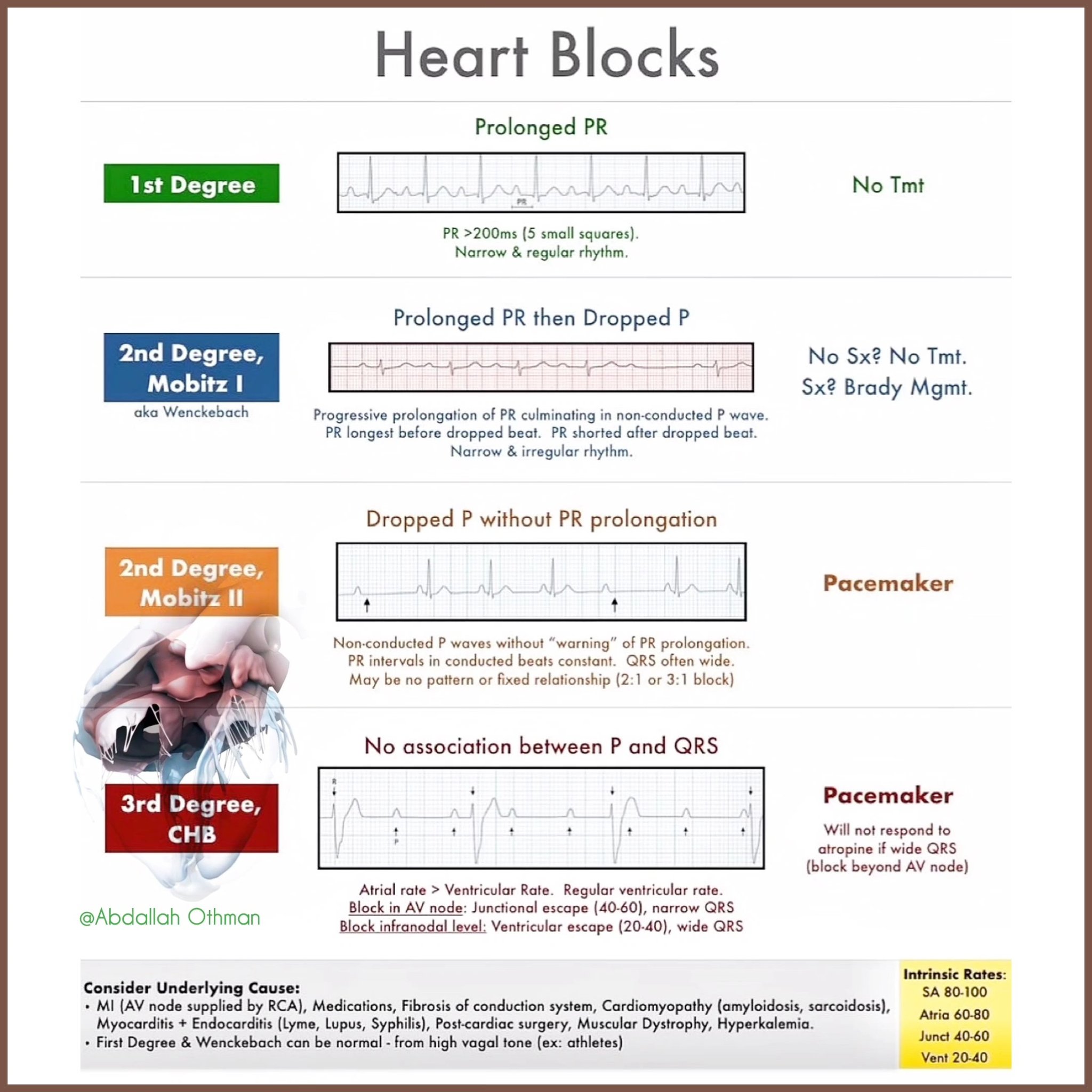 Classification of AV blocks in cardiology