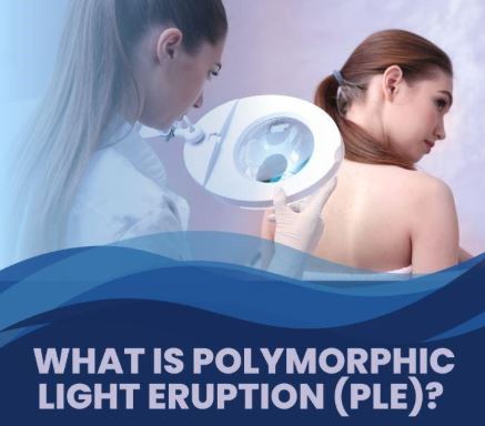 Aberdeenshire - Polymorphic Light Eruption (PLE) is a common rash ...