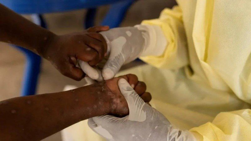 Addis - #Amhara region confirms first two Mpox cases in Bahir Dar ...