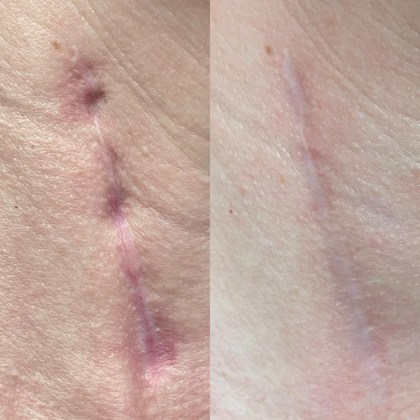 The Needle - This before-and-after holds a special place in my heart ...