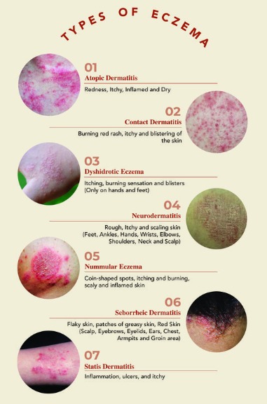 Options - Different Types of Eczema to Be Aware Of: | Facebook
