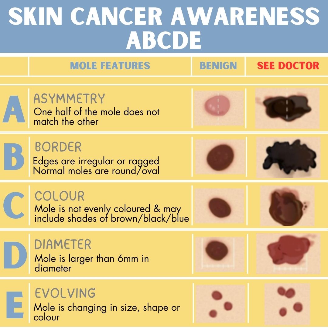 Aesthete - 🩺 The ABCDE of Skin Cancer 🩺 Knowing how to spot potential ...