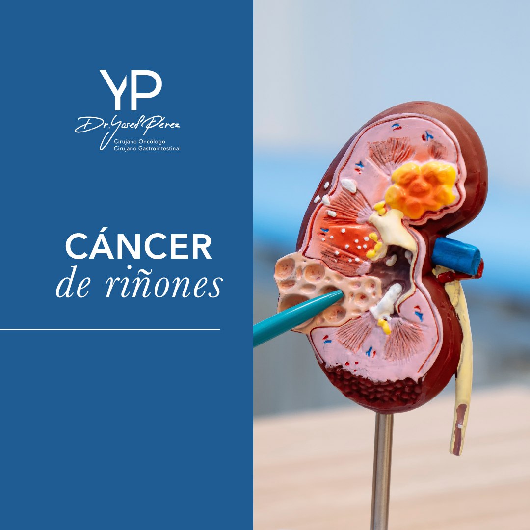 Cáncer de riñones 🦀 En los adultos, el carcinoma de células renales es ...
