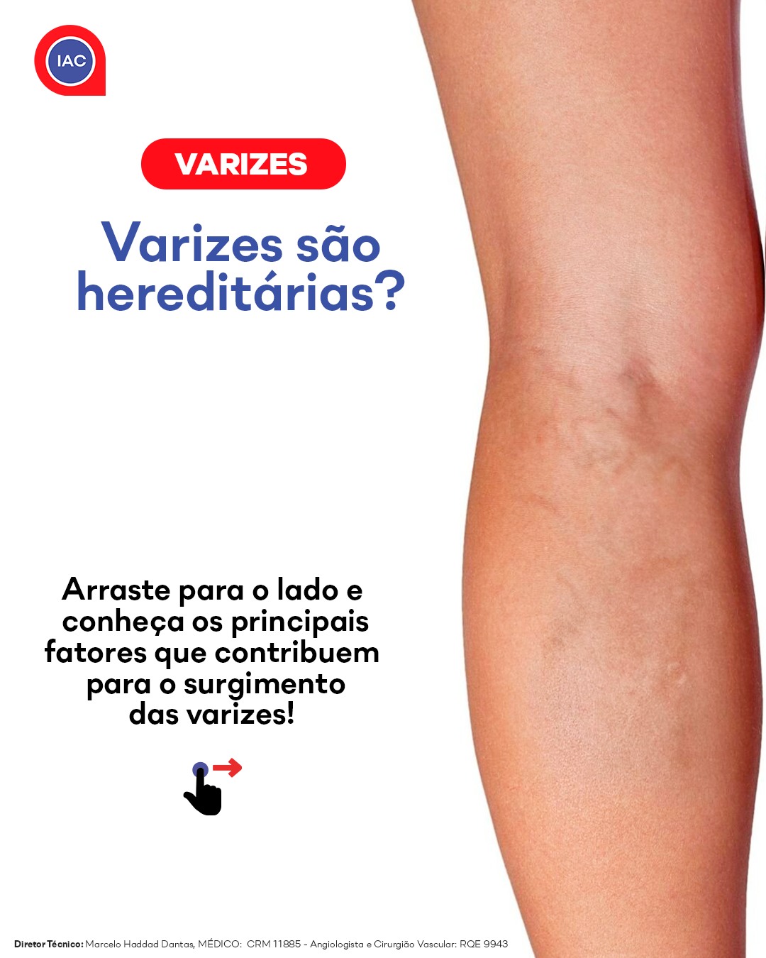 as-varizes-s-o-dilata-es-das-veias-que-podem-surgir-em-v-rias-partes