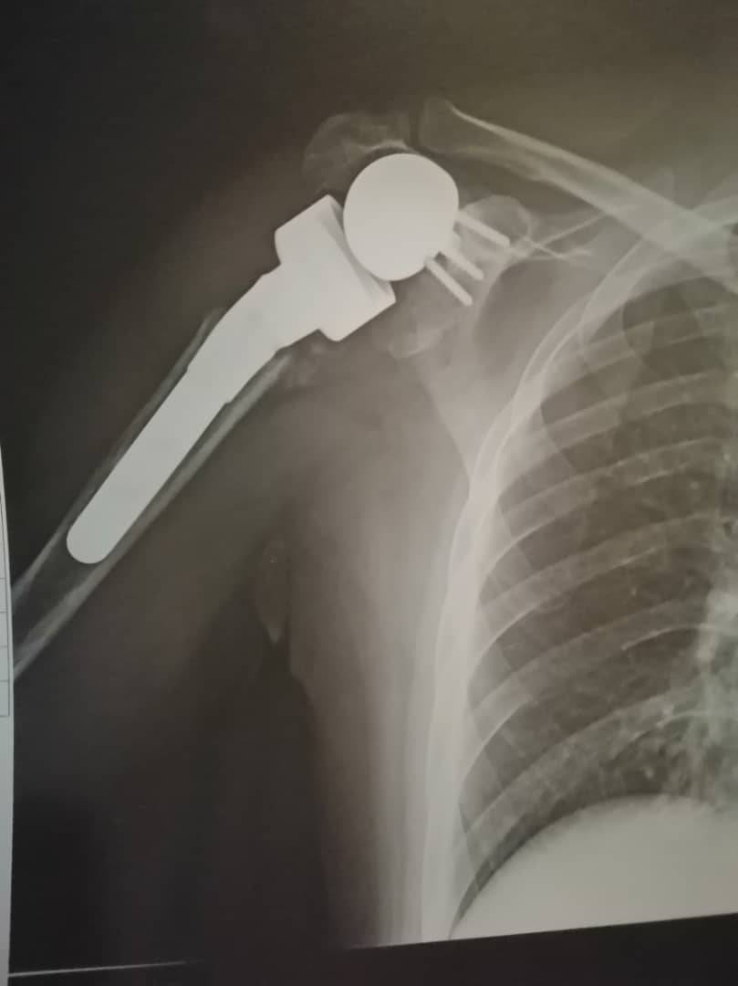 Professor - Reverse shoulder replacements: Restores function ⚠️ Comes ...