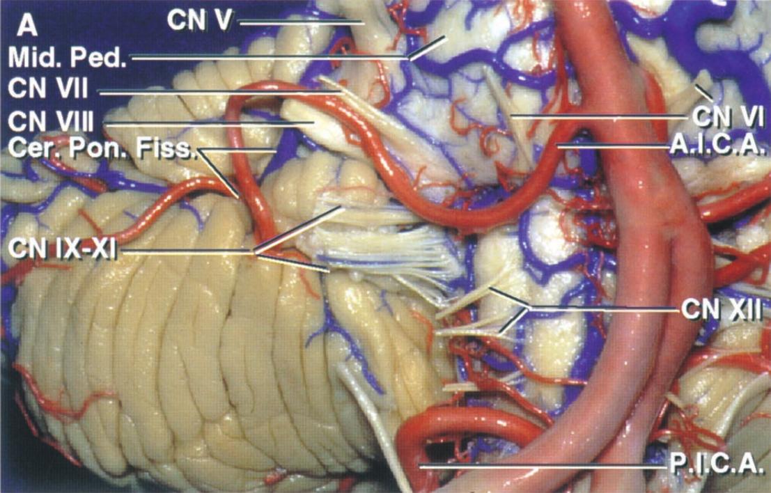 Neuroanatomy - Anatomía de la Arteria cerebelosa anteroinferior (AICA ...