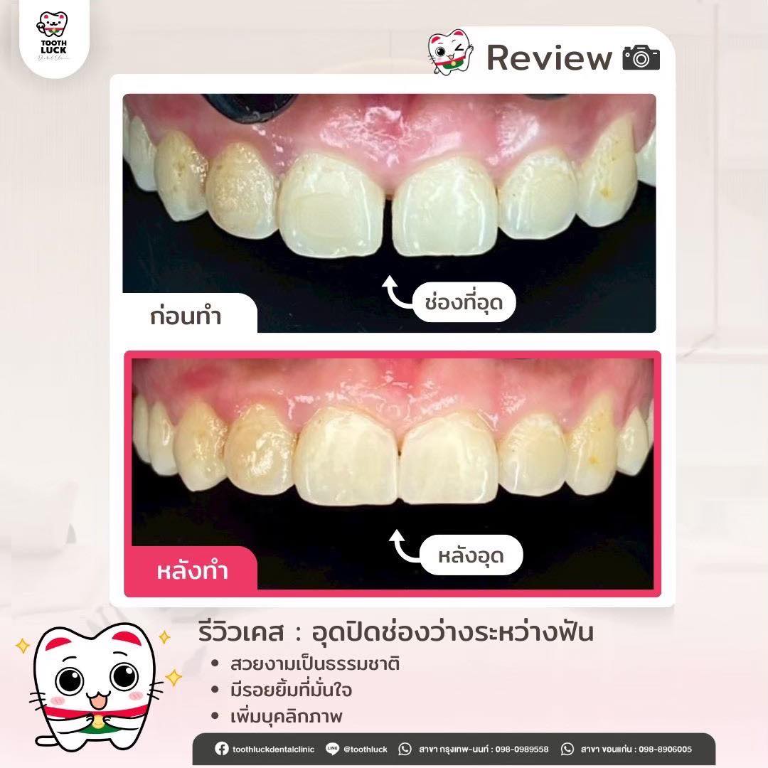 Tooth - 🦷 รีวิวเคส : อุดปิดช่องฟันหน้า ช่องห่างชัด ยิ้มทีสะดุดตา ก่อนทำ ...