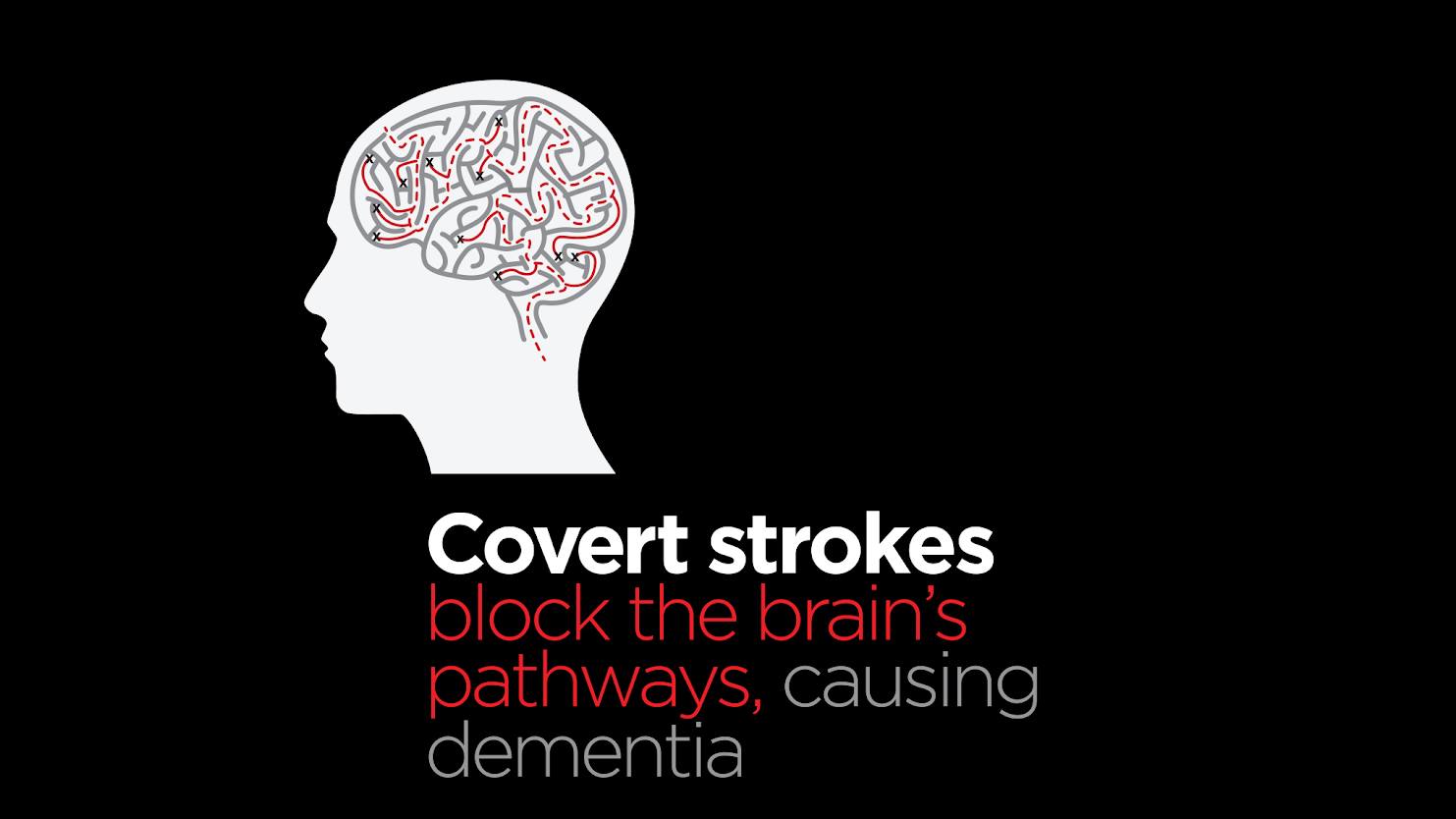 Country - 🧠 Stroke and Dementia – What You Need to Know 💡 Stroke ...