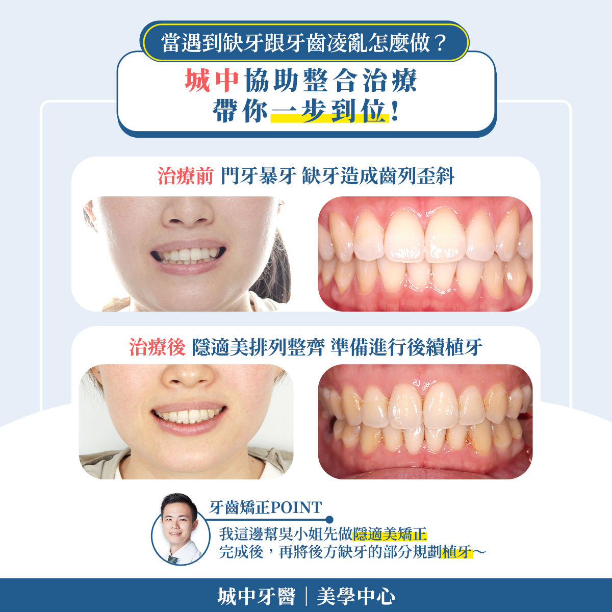 談談隱適美｜葉銘錕 醫師 個案主角：吳小姐... - 城中牙醫 美學中心｜留美醫師 隱適美、美白貼片 | Facebook