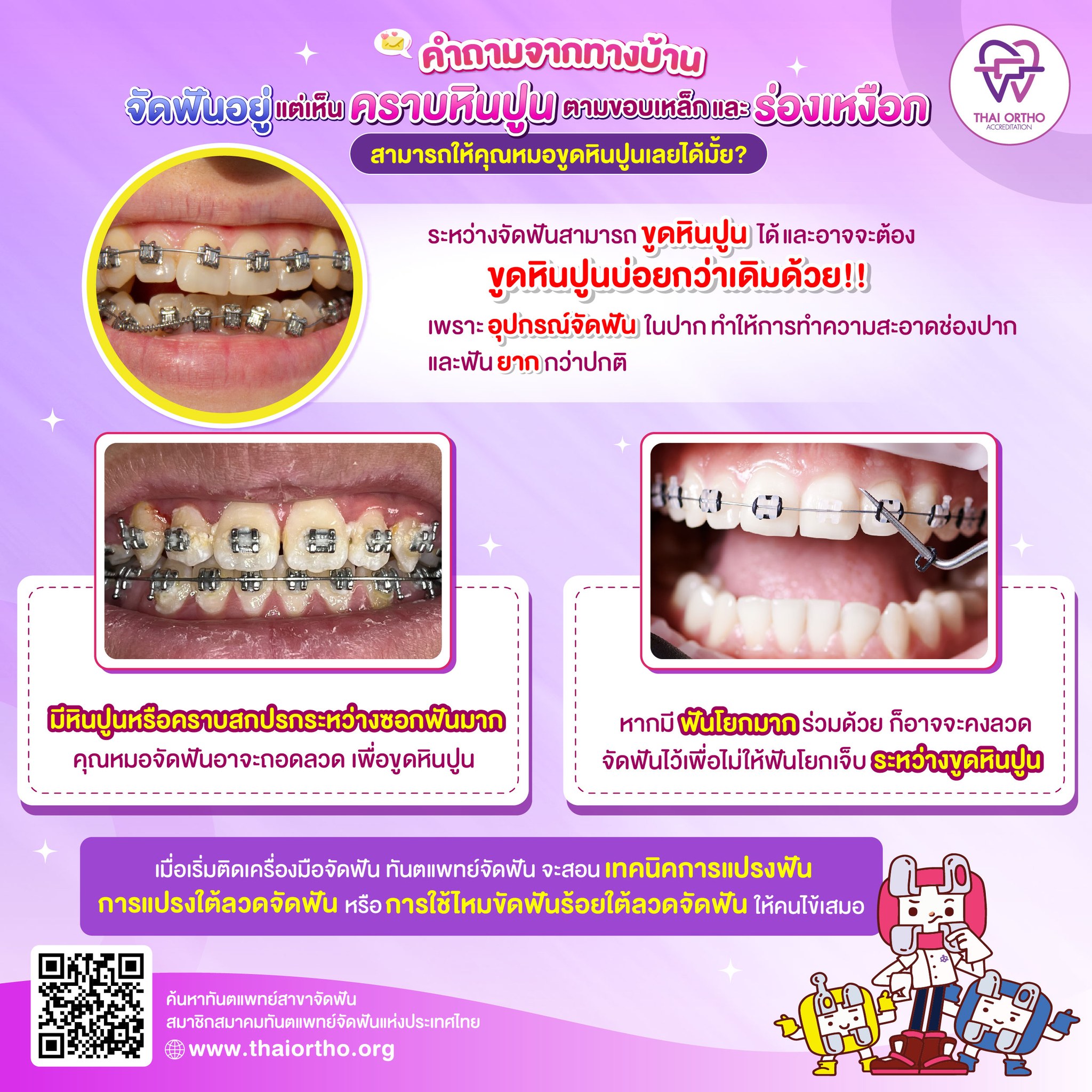 หมอจัดฟันไทย - #คำถามจากทางบ้าน : จัดฟันอยู่ แต่เริ่มเห็นคราบหินปูน ตาม ...