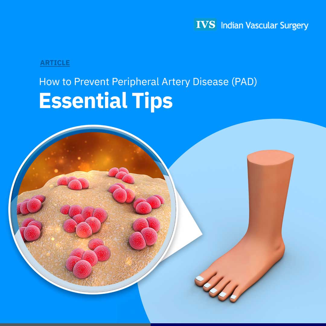 Dr. - Peripheral Artery Disease (PAD) occurs when blockages in the ...