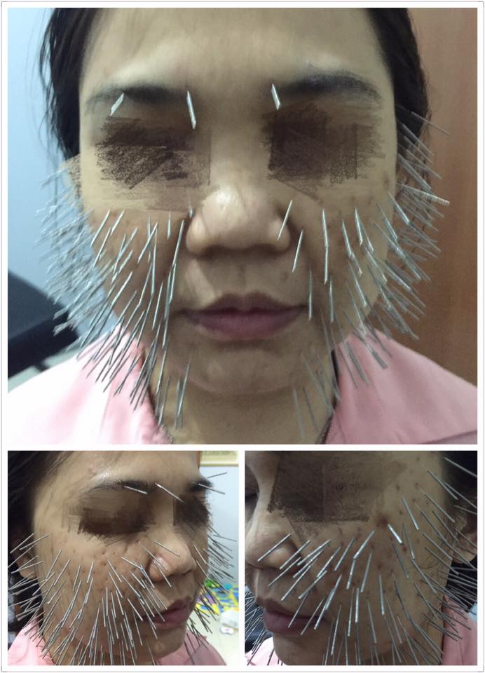 Neng Liang Health Care 脸部下垂 脸部有班 针灸脸部可以提升脸部淡化脸上的班 针灸脸部还可以调五藏 如果有什么问题可以打电话咨询我们 012 7700426 03 74966326 Facebook