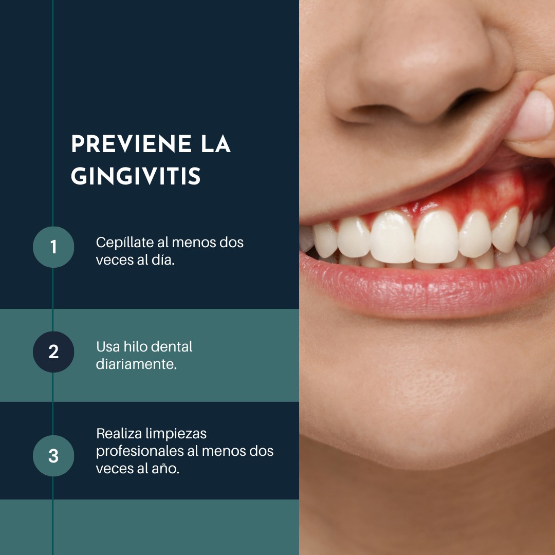 Dentall Clínica - ¿Qué es la Gingivitis y Cómo Prevenirla? 🦷 La ...
