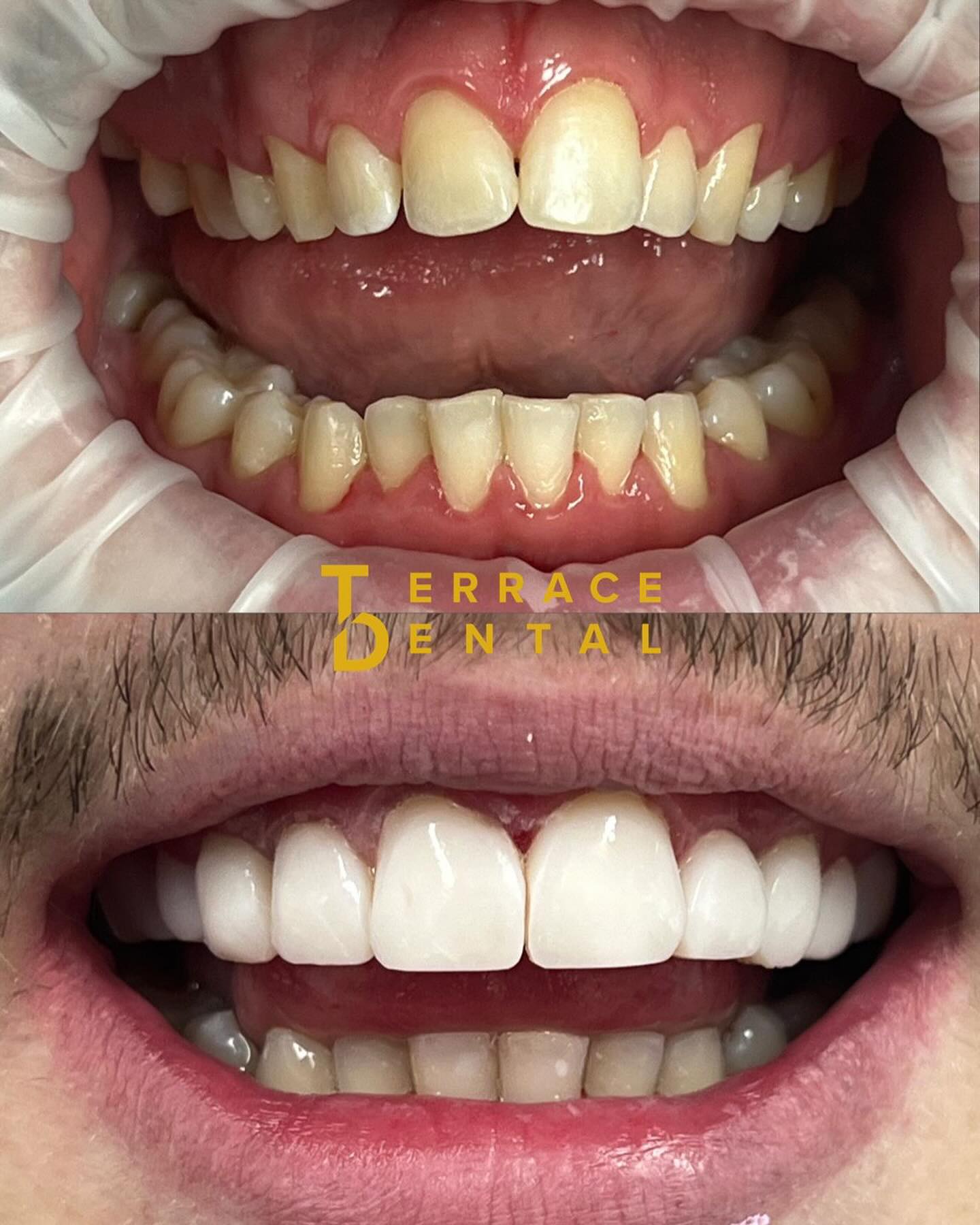 Terrace Dental - The POWER of Composite Bonding … Are... | Facebook