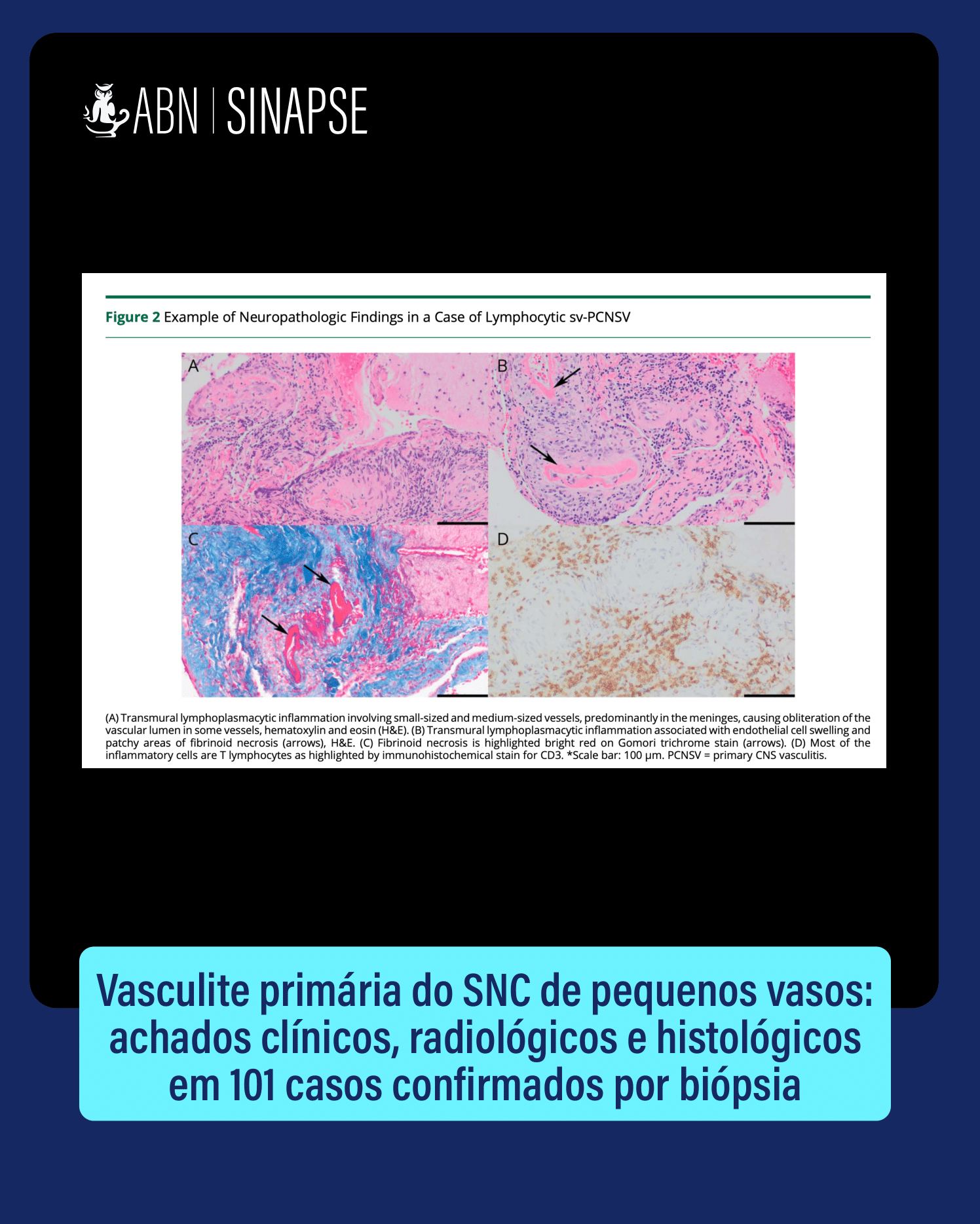 Academia - A vasculite primária do sistema nervoso central (VPSNC