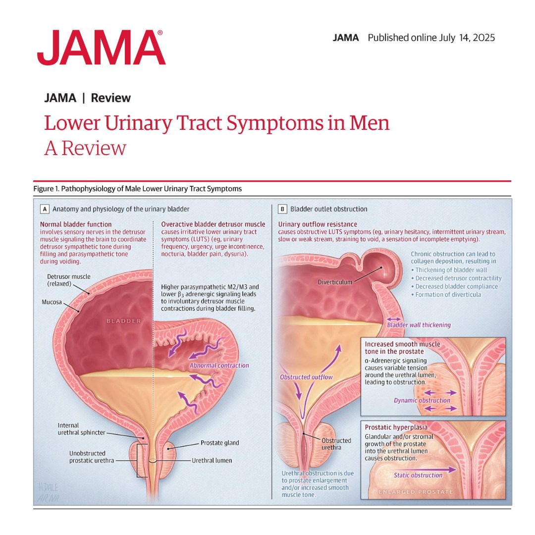 Fresh Look at Jama Lower Urinary Tract Symptoms Are Common Among Men And