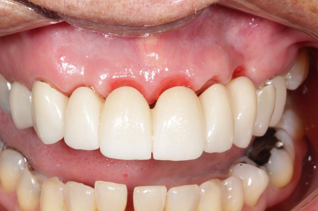 Dental - Tissue shaping & training with well-done provisionals, all on ...