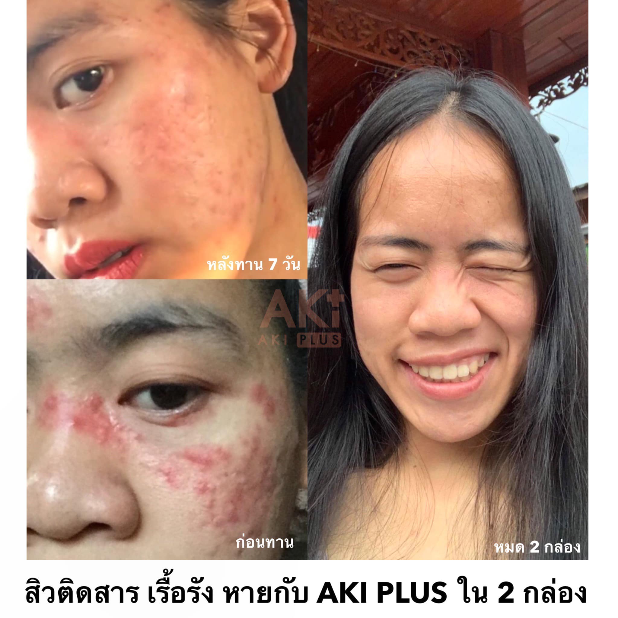 กินอะไรก็ไม่หาย แต่กินตัวนี้หายเกลี้ยง!! ไม่เชื่อก็ต้องเชื่อ👍🏻 Aki Plus ...