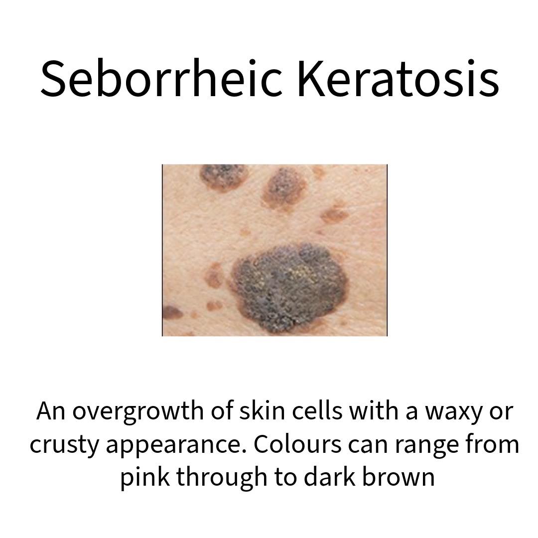 What is Seborrheic Keratosis? These are... - The Nurse Clinic | Facebook
